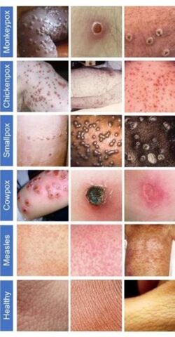 The appearance of a lesion or rash varies depending on the virus causing an infection.
Source: Islam T., et al./bioRxiv, 2022 under a CC-BY-ND 4.0 license
